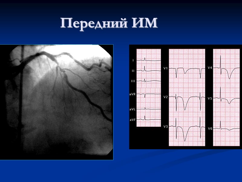 Передний ИМ